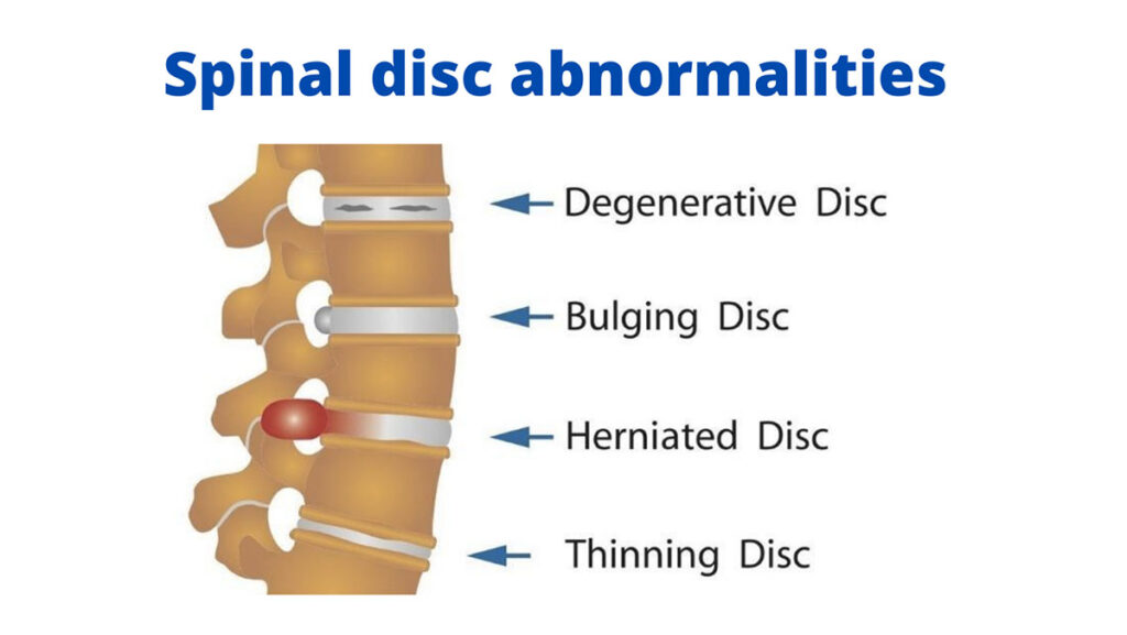 Disc Loss Stem Cell Treatment Prevent Degenerative Disc Disease and Decrease Back ...